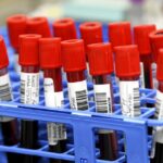 Κορονοϊός: Μικρότερος ο κίνδυνος λοίμωξης για τα άτομα με ομάδα αίματος Ο