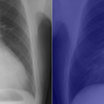 AI transforms the humble chest X-ray into a better diagnostic tool